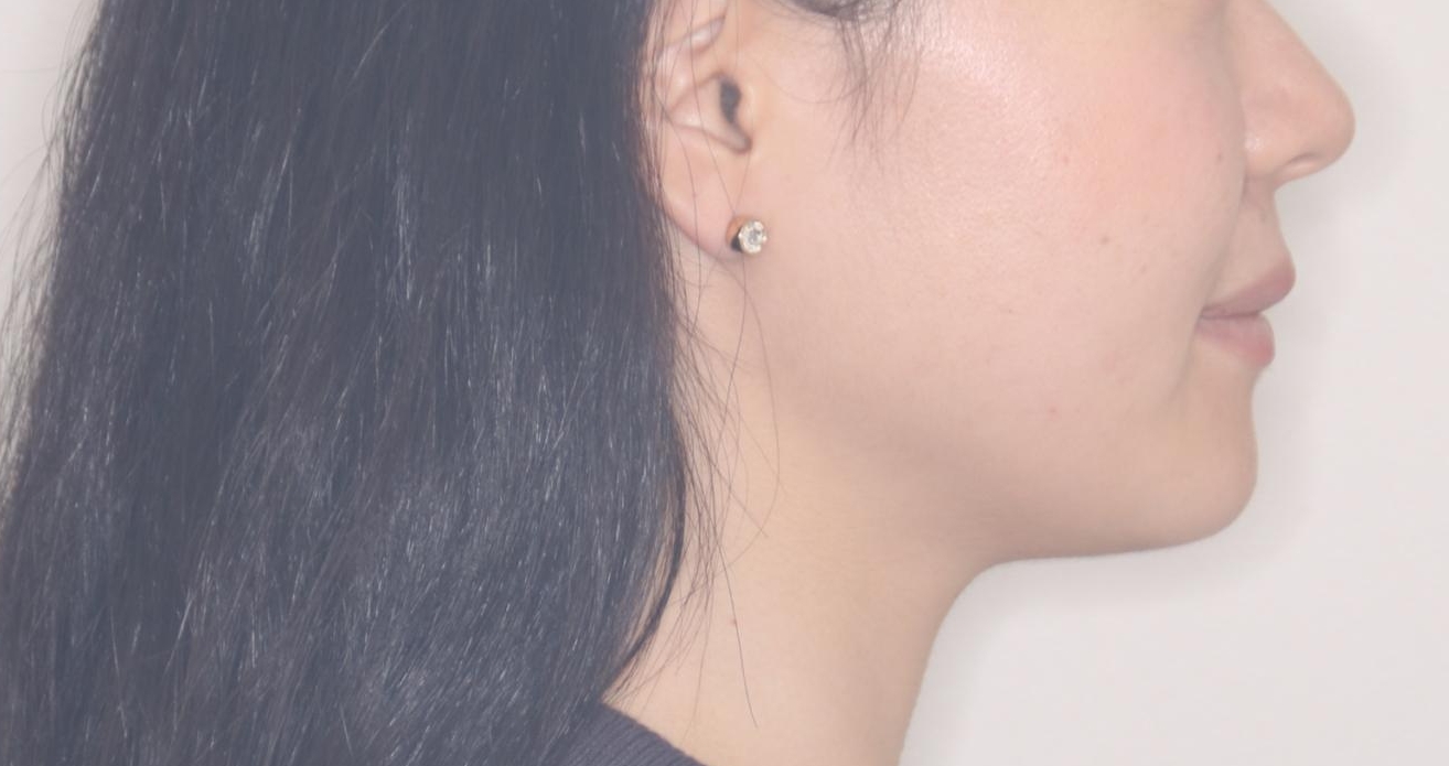 【ワイヤー矯正】口元を下げたい、下の歯の凹凸を無くしたいの治療後(顔貌)