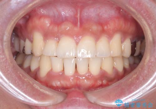 【ワイヤー矯正】八重歯と下の歯の凸凹を治したいの治療後