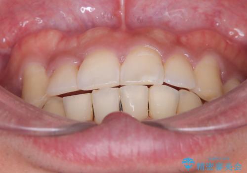 【ワイヤー矯正】八重歯と下の歯の凸凹を治したいの治療後