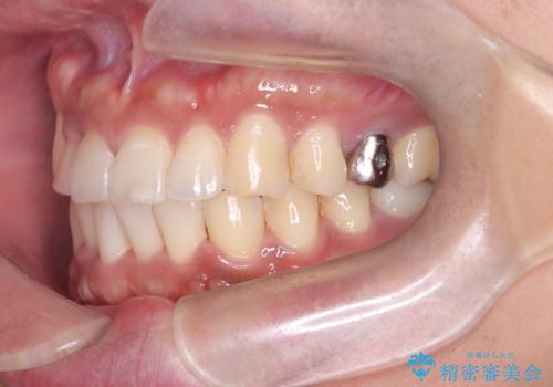 【ワイヤー矯正】八重歯と下の歯の凸凹を治したいの治療後