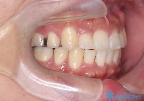 【ワイヤー矯正】八重歯と下の歯の凸凹を治したいの治療後