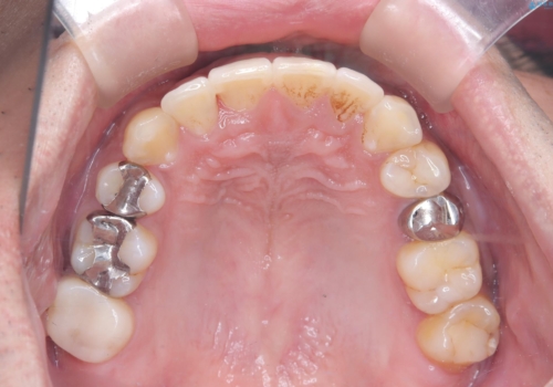【ワイヤー矯正】八重歯と下の歯の凸凹を治したいの治療後