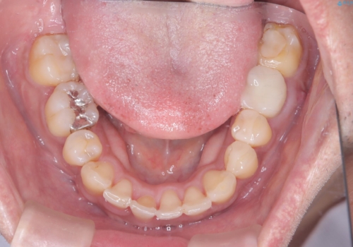 【ワイヤー矯正】八重歯と下の歯の凸凹を治したいの治療後