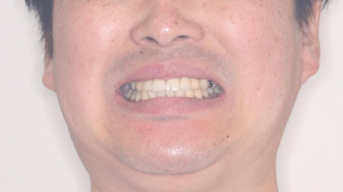 【ワイヤー矯正】八重歯と下の歯の凸凹を治したいの治療後(顔貌)