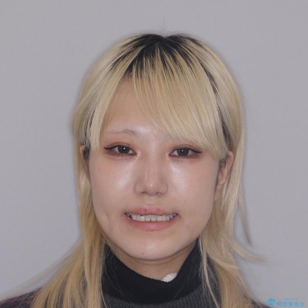 【モニター】前歯のデコボコをインビザラインで綺麗にの治療前(顔貌)