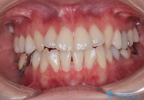 【モニター】前歯のデコボコをインビザラインで綺麗にの治療前