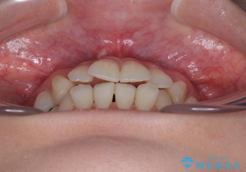 【モニター】前歯のデコボコをインビザラインで綺麗にの治療前