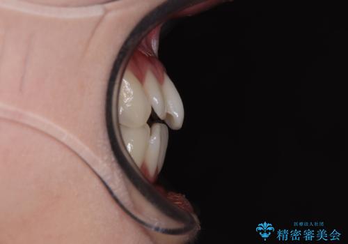 【モニター】前歯のデコボコをインビザラインで綺麗にの治療前