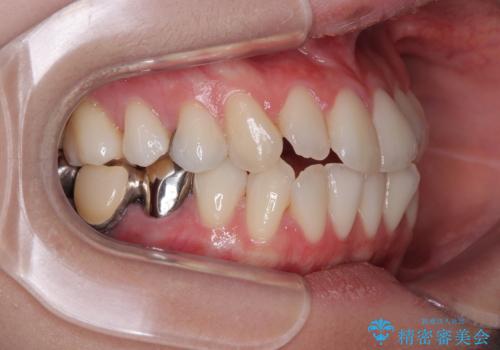 【モニター】前歯のデコボコをインビザラインで綺麗にの治療前