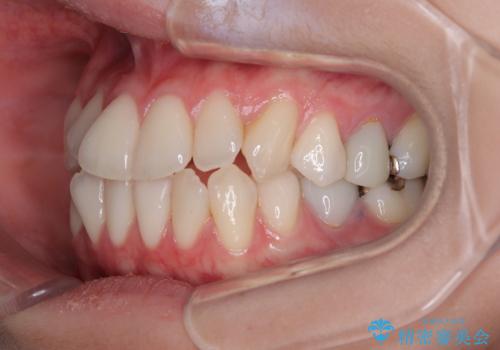 【モニター】前歯のデコボコをインビザラインで綺麗にの治療前