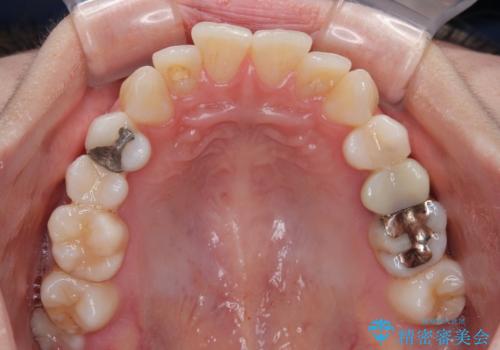 【モニター】前歯のデコボコをインビザラインで綺麗にの治療前