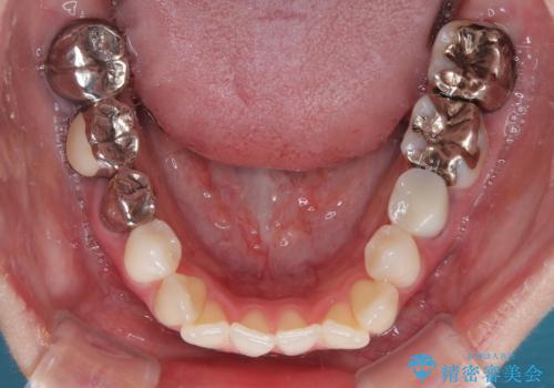 【モニター】前歯のデコボコをインビザラインで綺麗にの治療前