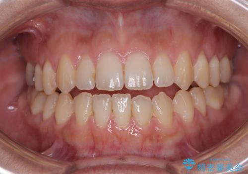 【モニター】食事が取りづらい 極端な開咬をインビザラインで解決の治療中