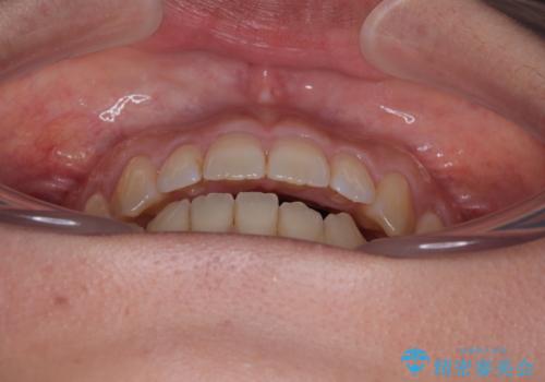 【モニター】食事が取りづらい　極端な開咬をインビザラインで解決の治療中