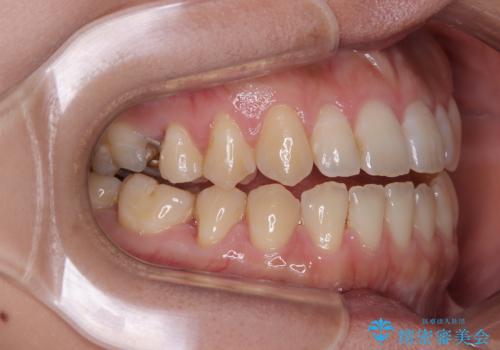 【モニター】食事が取りづらい 極端な開咬をインビザラインで解決の治療中