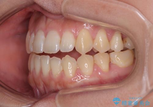 【モニター】食事が取りづらい　極端な開咬をインビザラインで解決の治療中