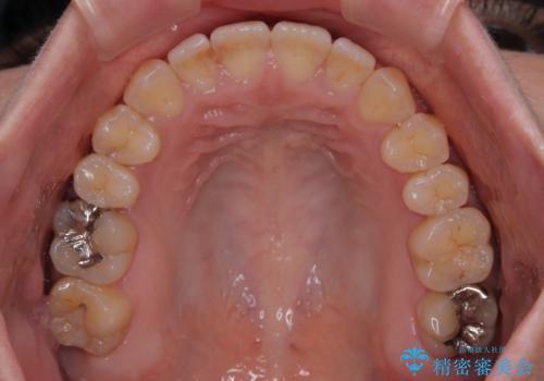 【モニター】食事が取りづらい 極端な開咬をインビザラインで解決の治療中