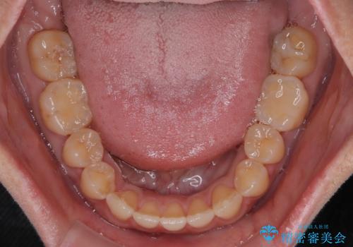 【モニター】食事が取りづらい　極端な開咬をインビザラインで解決の治療中