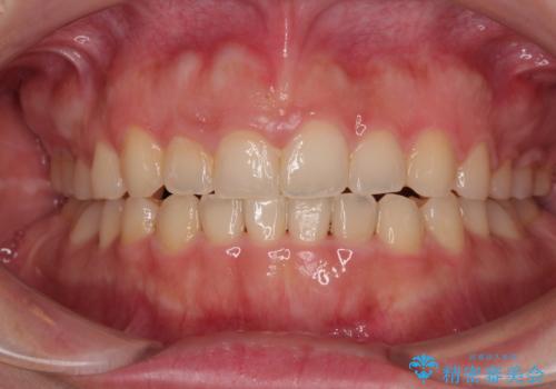 捻れて前に出ている前歯　ワイヤー装置での非抜歯矯正の症例 治療後