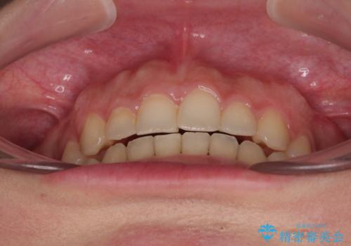 捻れて前に出ている前歯　ワイヤー装置での非抜歯矯正の治療後