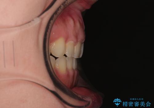 捻れて前に出ている前歯 ワイヤー装置での非抜歯矯正の治療後