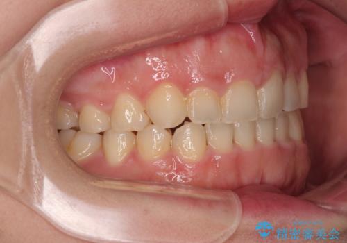 捻れて前に出ている前歯 ワイヤー装置での非抜歯矯正の治療後