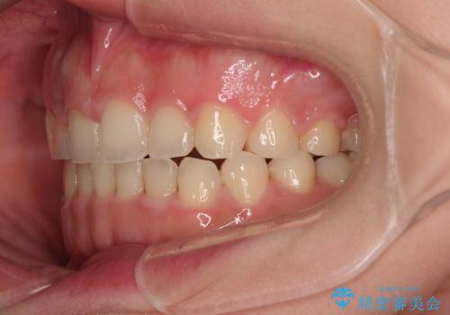 捻れて前に出ている前歯　ワイヤー装置での非抜歯矯正の治療後