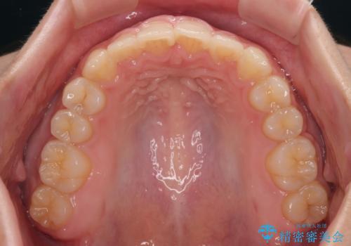 捻れて前に出ている前歯　ワイヤー装置での非抜歯矯正の治療後