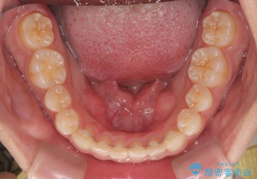 捻れて前に出ている前歯 ワイヤー装置での非抜歯矯正の治療後