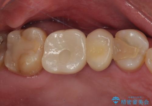 割れてしまった奥歯　1DAYインプラント治療の治療後