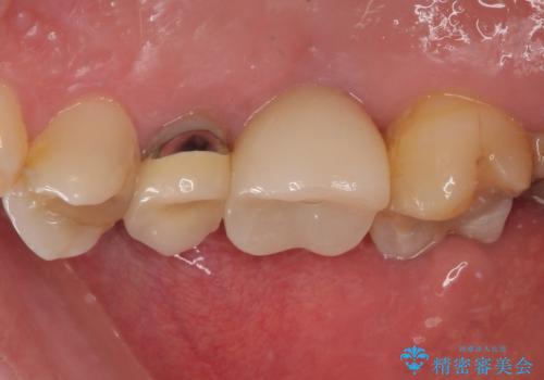 割れてしまった奥歯 1DAYインプラント治療の治療後