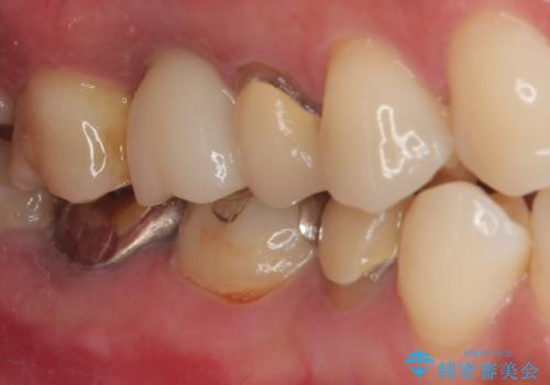 割れてしまった奥歯 1DAYインプラント治療の治療後