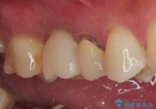 割れてしまった奥歯 1DAYインプラント治療の治療後