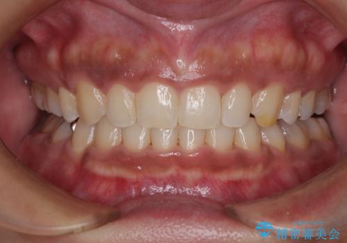 抜歯矯正で口が閉じやすく|ディープバイトと叢生を改善した症例の症例 治療後