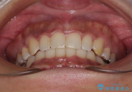 抜歯矯正で口が閉じやすく|ディープバイトと叢生を改善した症例の治療後