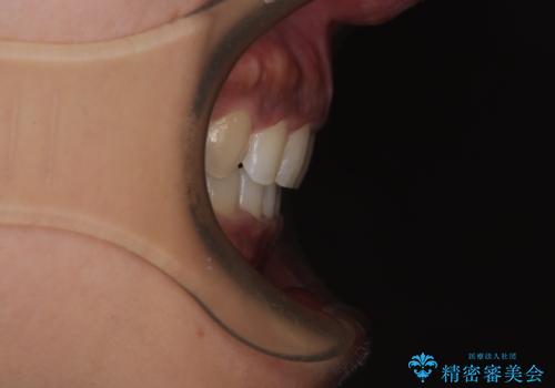 抜歯矯正で口が閉じやすく|ディープバイトと叢生を改善した症例の治療後