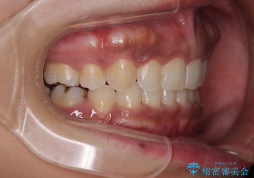 抜歯矯正で口が閉じやすく|ディープバイトと叢生を改善した症例の治療後