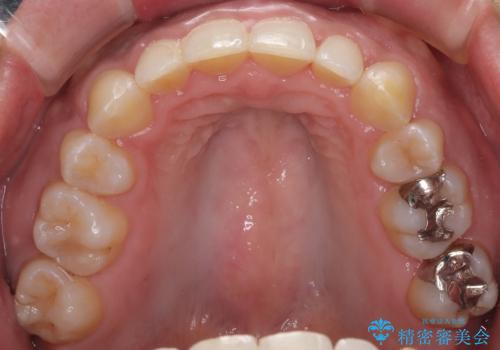 抜歯矯正で口が閉じやすく|ディープバイトと叢生を改善した症例の治療後