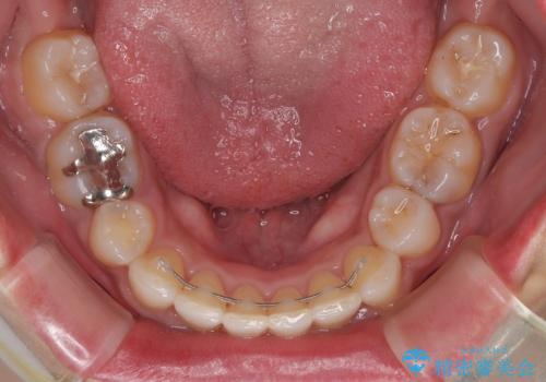 抜歯矯正で口が閉じやすく|ディープバイトと叢生を改善した症例の治療後