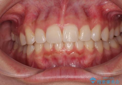 デコボコと咬み合わせを改善 インビザライン矯正治療の治療後