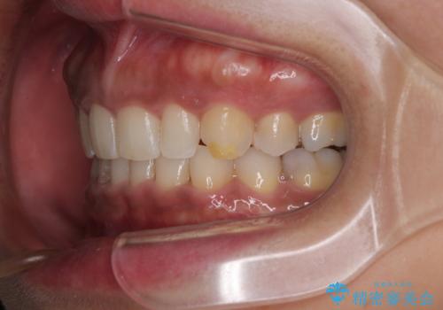 抜歯矯正で口が閉じやすく|ディープバイトと叢生を改善した症例の治療後