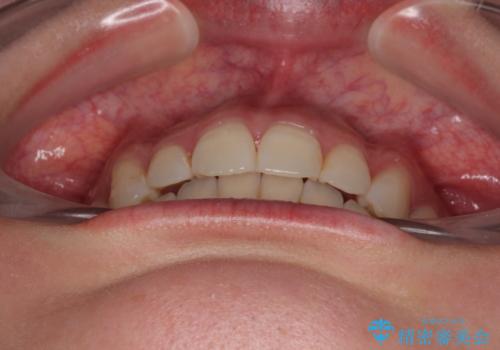 デコボコと咬み合わせを改善　インビザライン矯正治療の治療後