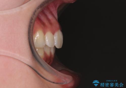 デコボコと咬み合わせを改善　インビザライン矯正治療の治療後
