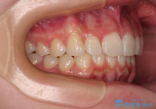 デコボコと咬み合わせを改善　インビザライン矯正治療の治療後