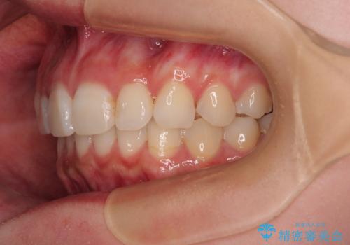 デコボコと咬み合わせを改善 インビザライン矯正治療の治療後