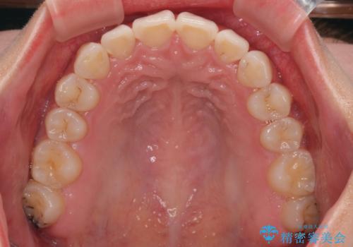 デコボコと咬み合わせを改善 インビザライン矯正治療の治療後