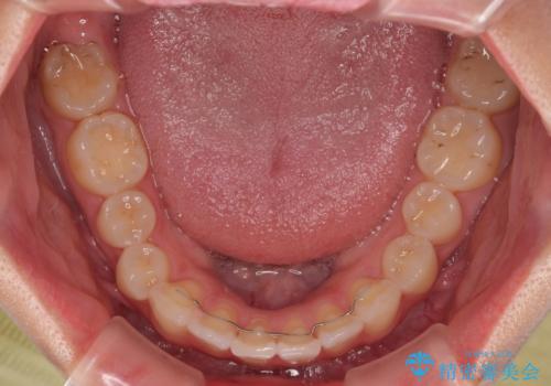 デコボコと咬み合わせを改善　インビザライン矯正治療の治療後