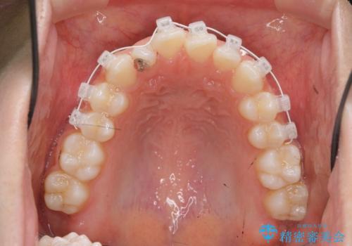 前歯のねじれ、がたつきをしっかり改善 部分ワイヤー+マウスピース矯正の治療前