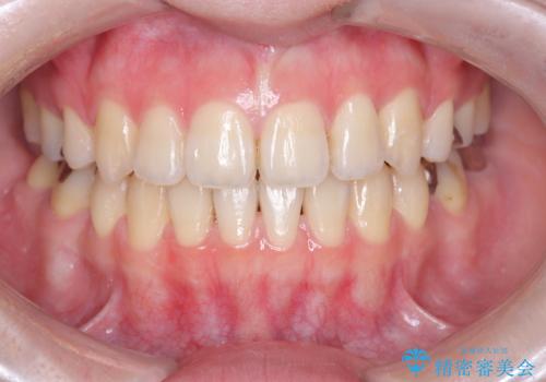 開咬・叢生(八重歯)を抜歯矯正で改善|ワイヤー矯正(クリア装置)症例の症例 治療後