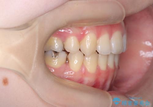 開咬・叢生(八重歯)を抜歯矯正で改善|ワイヤー矯正(クリア装置)症例の治療後